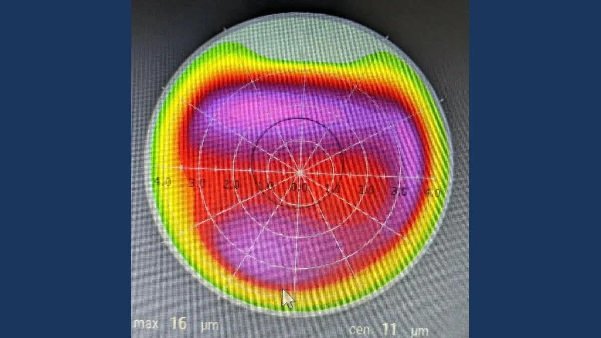 Cirugía Refractiva