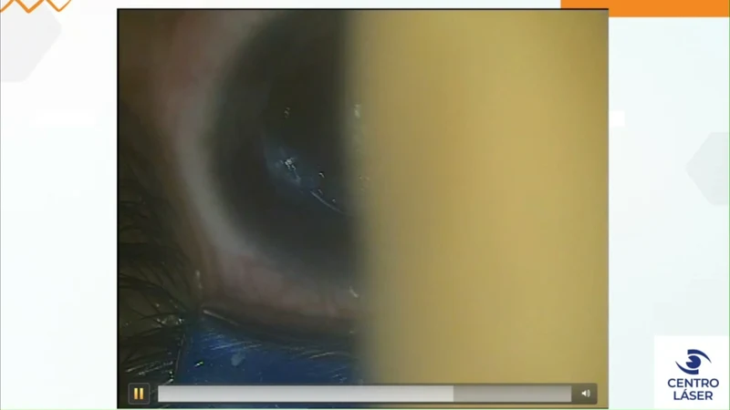 Pentacam pre y post CAIRS en queratoplastia penetrante