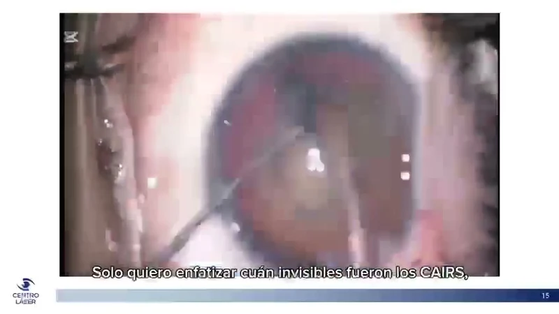 Cirugía de catarata con CAIRS integrado en la córnea