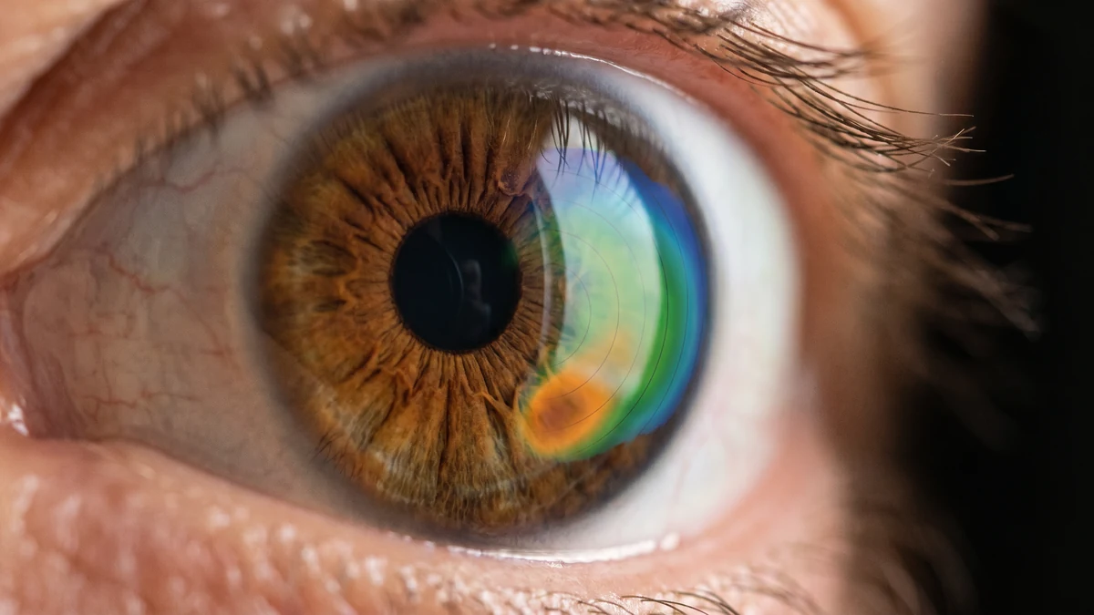 Still Seeing Poorly After Cataract Surgery: It Was Undiagnosed Keratoconus