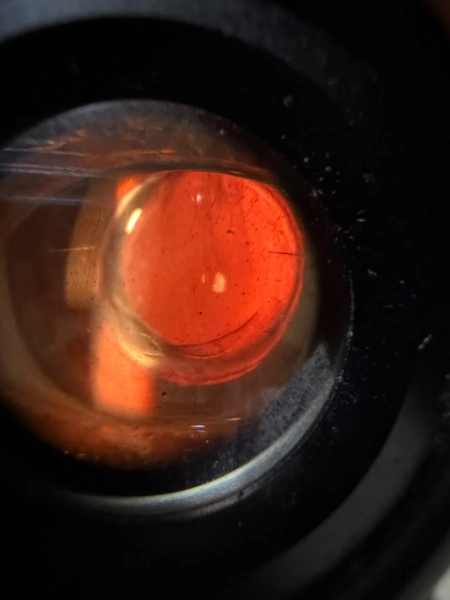 Retroiluminación del ojo derecho tras el implante, con el segmento corneal alogénico y el lente intraocular visibles
