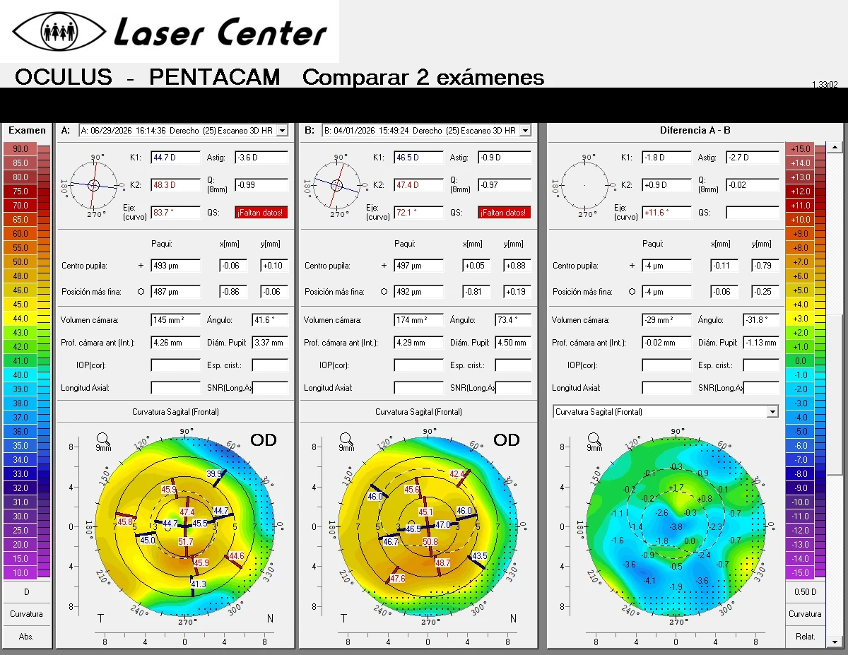 Comparación de tomografía corneal Pentacam del ojo derecho antes y un mes después del CAIRS, con mapa de diferencia