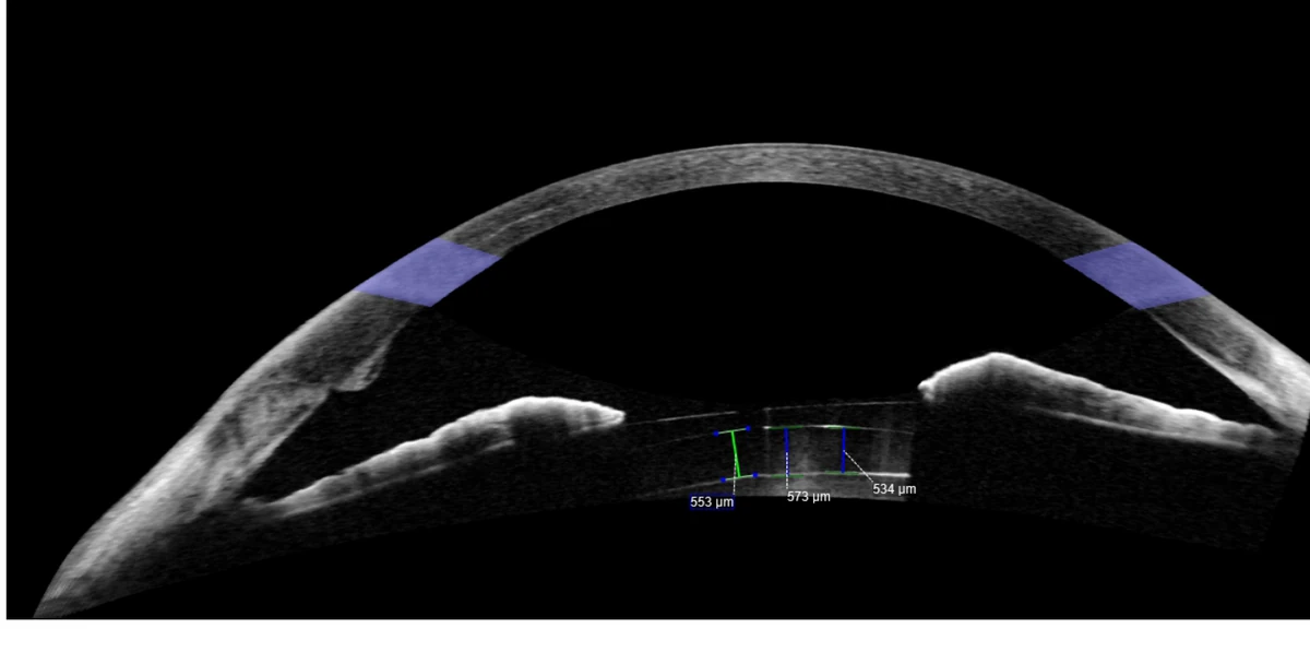 Cross-section tomography of the anterior segment of the eye, with the implanted lens between the iris and the crystalline lens and three separation measurements