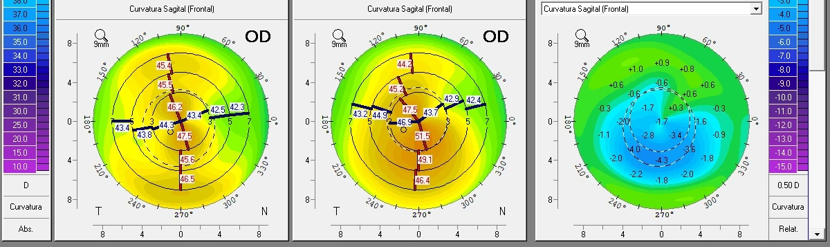 Three curvature maps of the same cornea: after the segments, before them, and the difference between the two