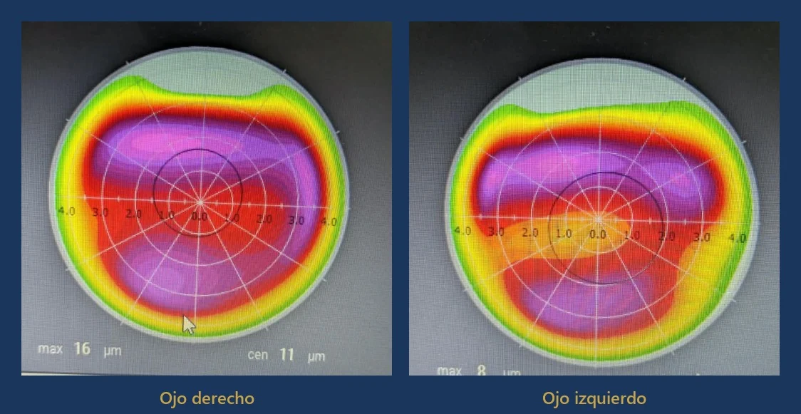 Dos mapas de ablación del mismo paciente, uno por ojo, con patrones de color distintos entre sí