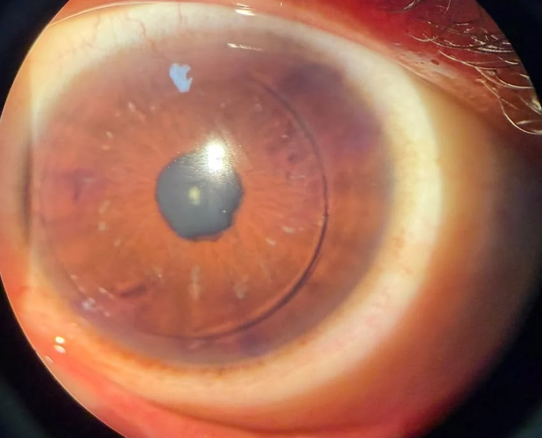 Ojo del paciente al día siguiente de la cirugía, con el borde circular del colgajo visible sobre la córnea y el borde de la pupila irregular por abajo