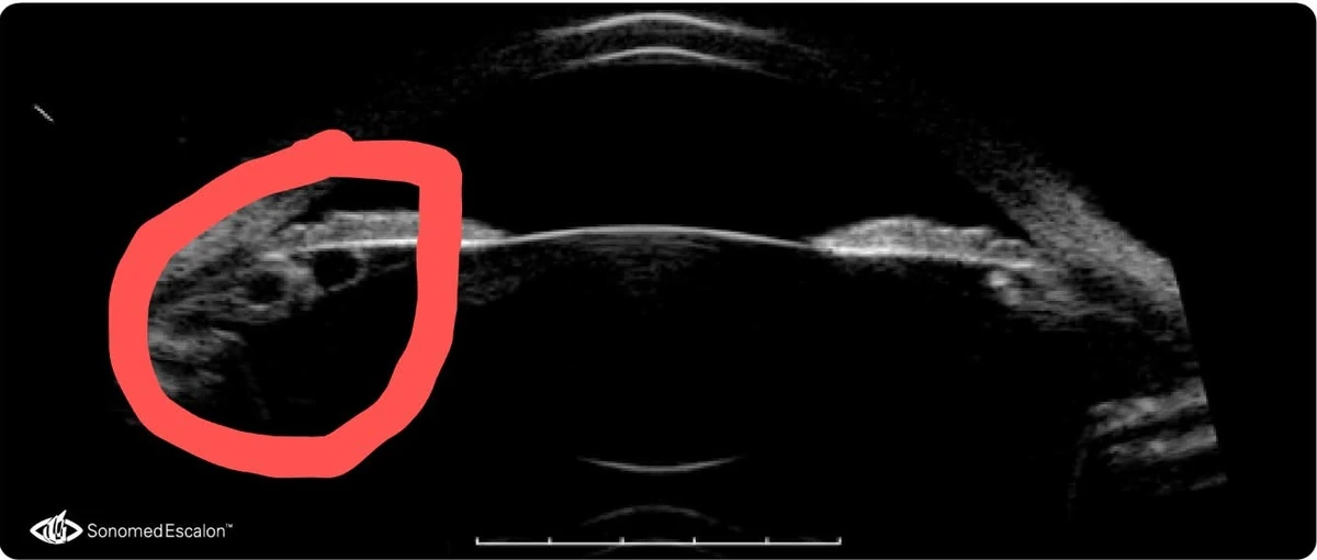 Ultrasound biomicroscopy of the eye, with a red circle marking two dark bubbles behind the iris